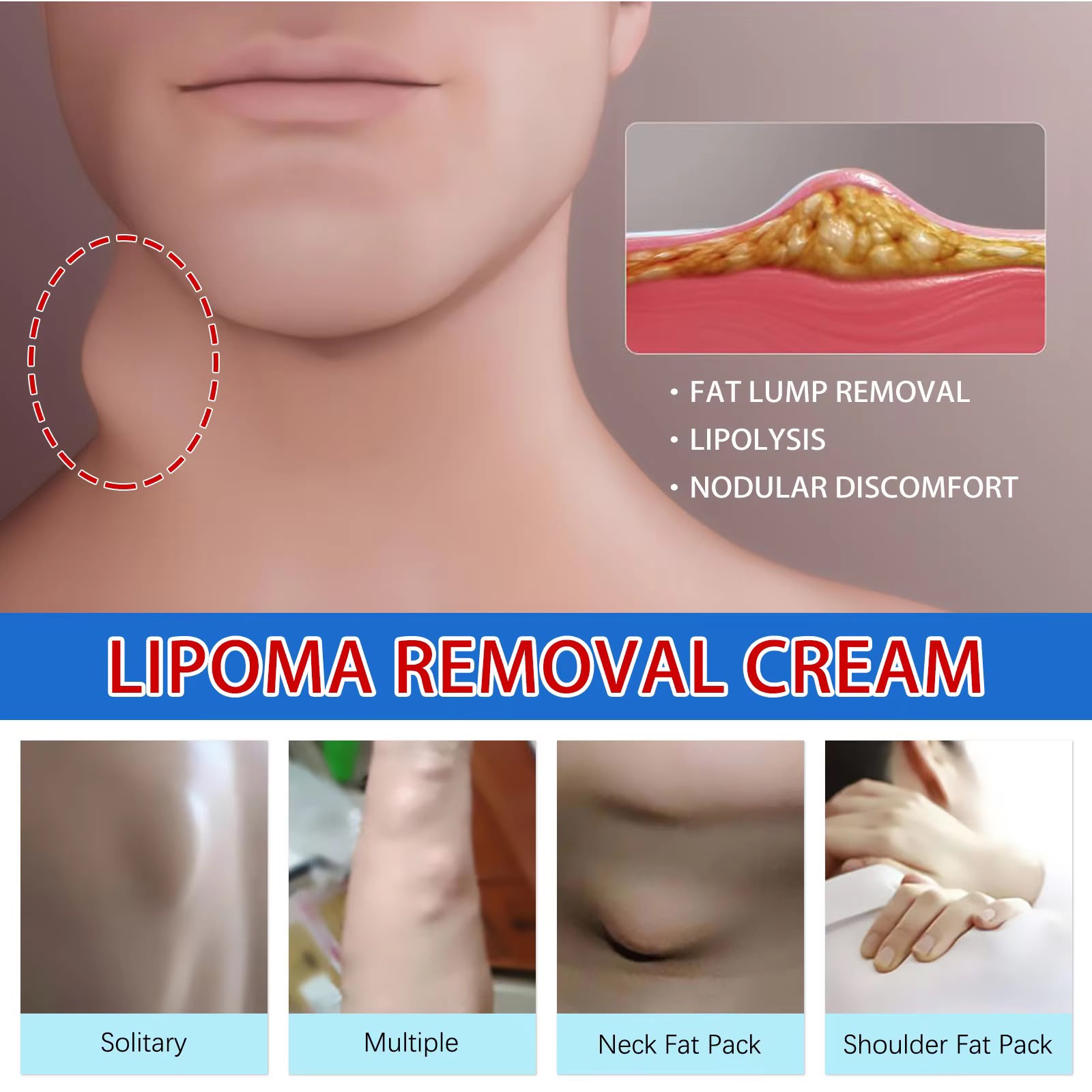 Lipoma Removal Cream
